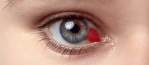 Göz İçi Kanamaları Neden Olur?