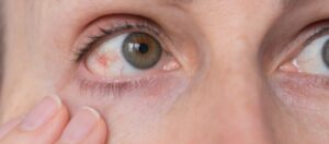 Goz Tansiyonu Glokom Nedir Goz Tansiyonu Belirtileri Nelerdir Göz Tansiyonu (Glokom) Nedir? Göz Tansiyonu Belirtileri Nelerdir?