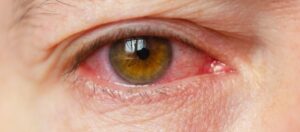 Konjonktivit Kirmizi Goz Hastaligi Nedir Belirtileri Nelerdir Konjonktivit (Kırmızı Göz Hastalığı) Nedir? Belirtileri Nelerdir?