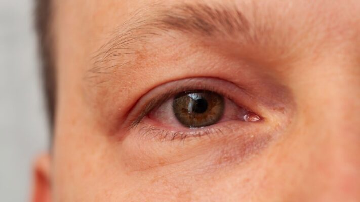 Goz Kapaklarinin Sismesi Hangi Hastaligin Belirtisidir Göz Kapaklarının Şişmesi Hangi Hastalığın Belirtisidir?