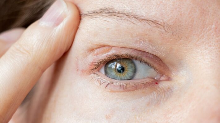 Lazer Sonrasi Sikayetler En Sik Yasanan Komplikasyonlar Lazer Sonrası Şikayetler - En Sık Yaşanan Komplikasyonlar